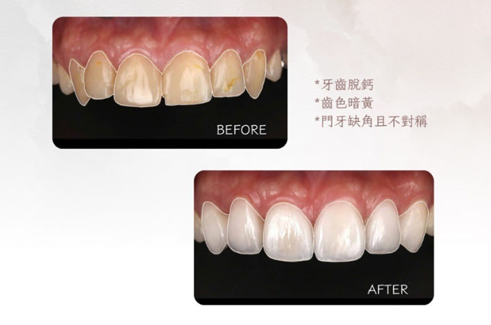 微笑美學DSD案例