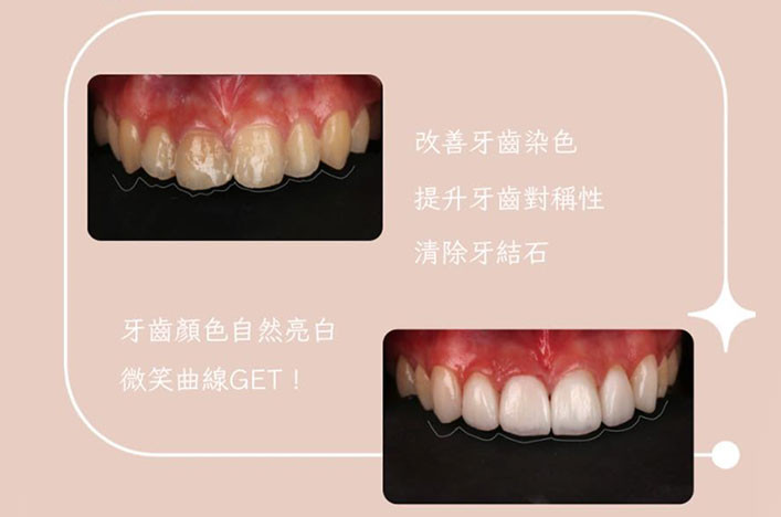 前牙美學貼片案例