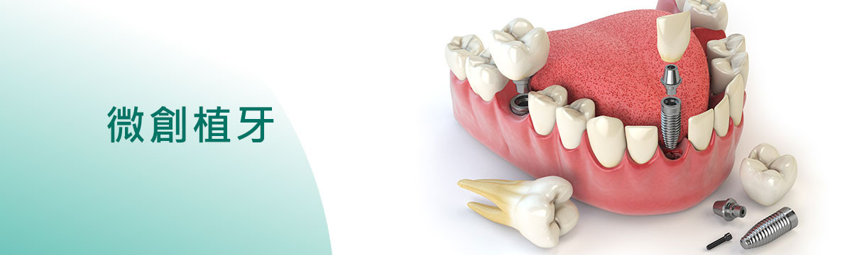 微創植牙