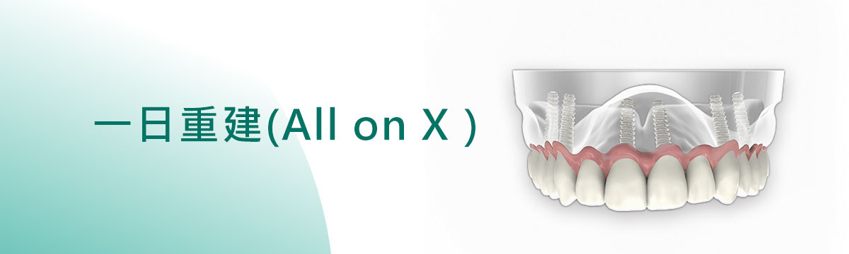 一日重建(All on X) 一日重建(All on X)