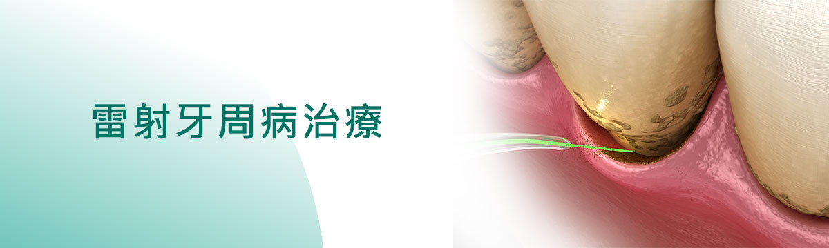 雷射牙周病治療 雷射牙周病治療